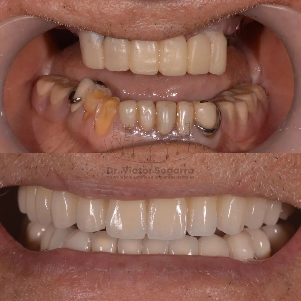 Antes y después Implantes Dentales Dr. Víctor Segarra