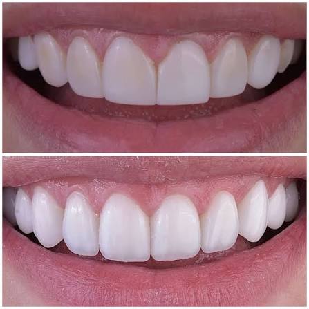 Caso Clínico Diseño de Sonrisa 1