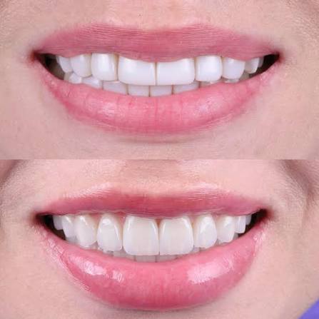 Prevención y Control Periodontal